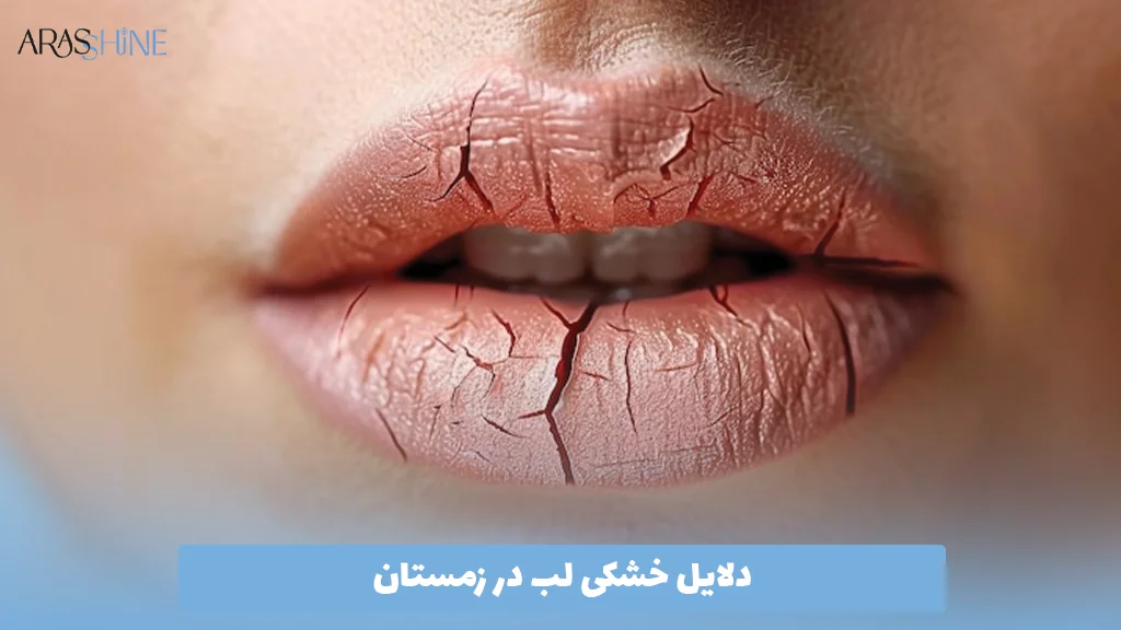 دلایل خشکی لب در زمستان